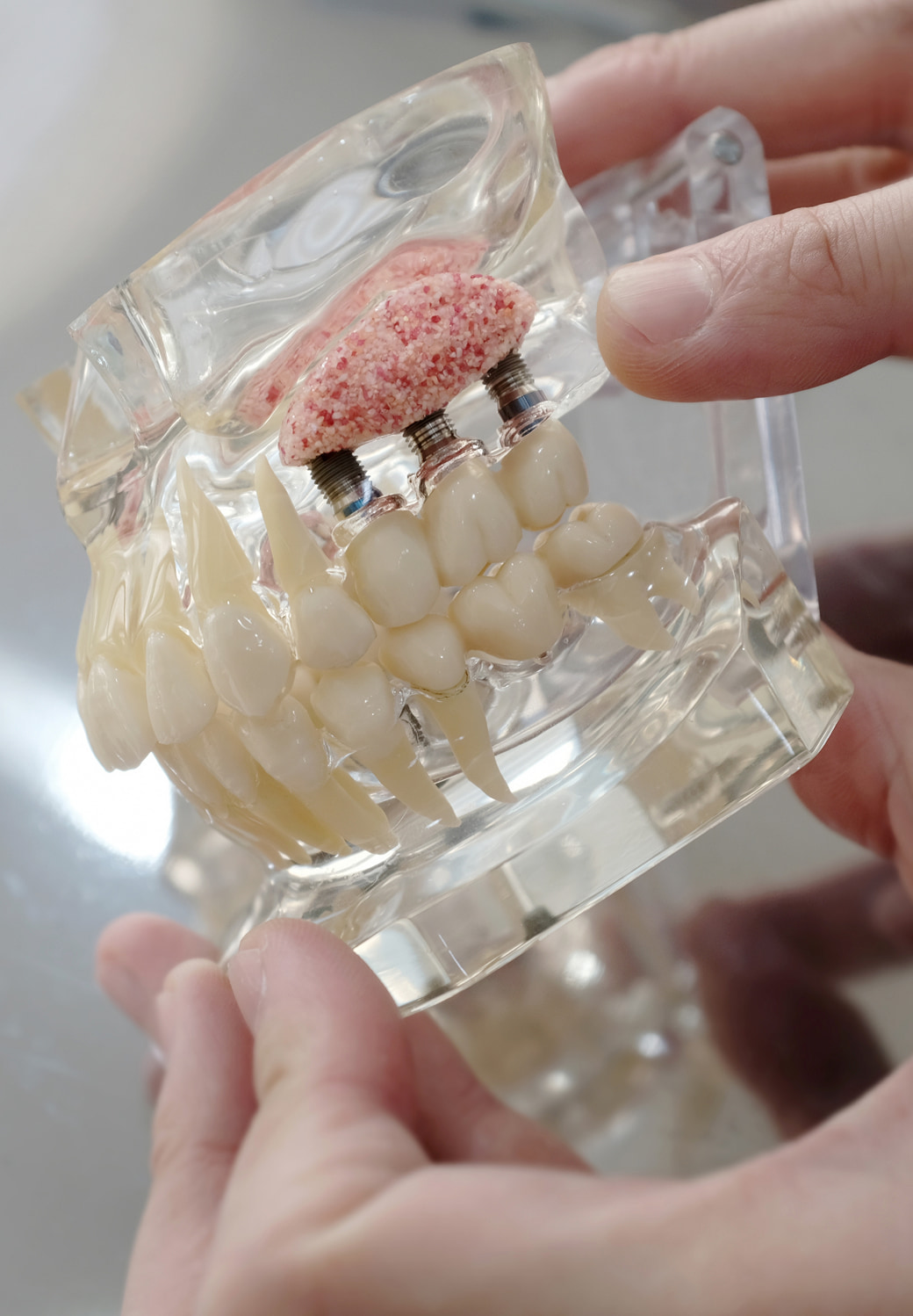 Bone Grafting Sinus Lifts Banner Image