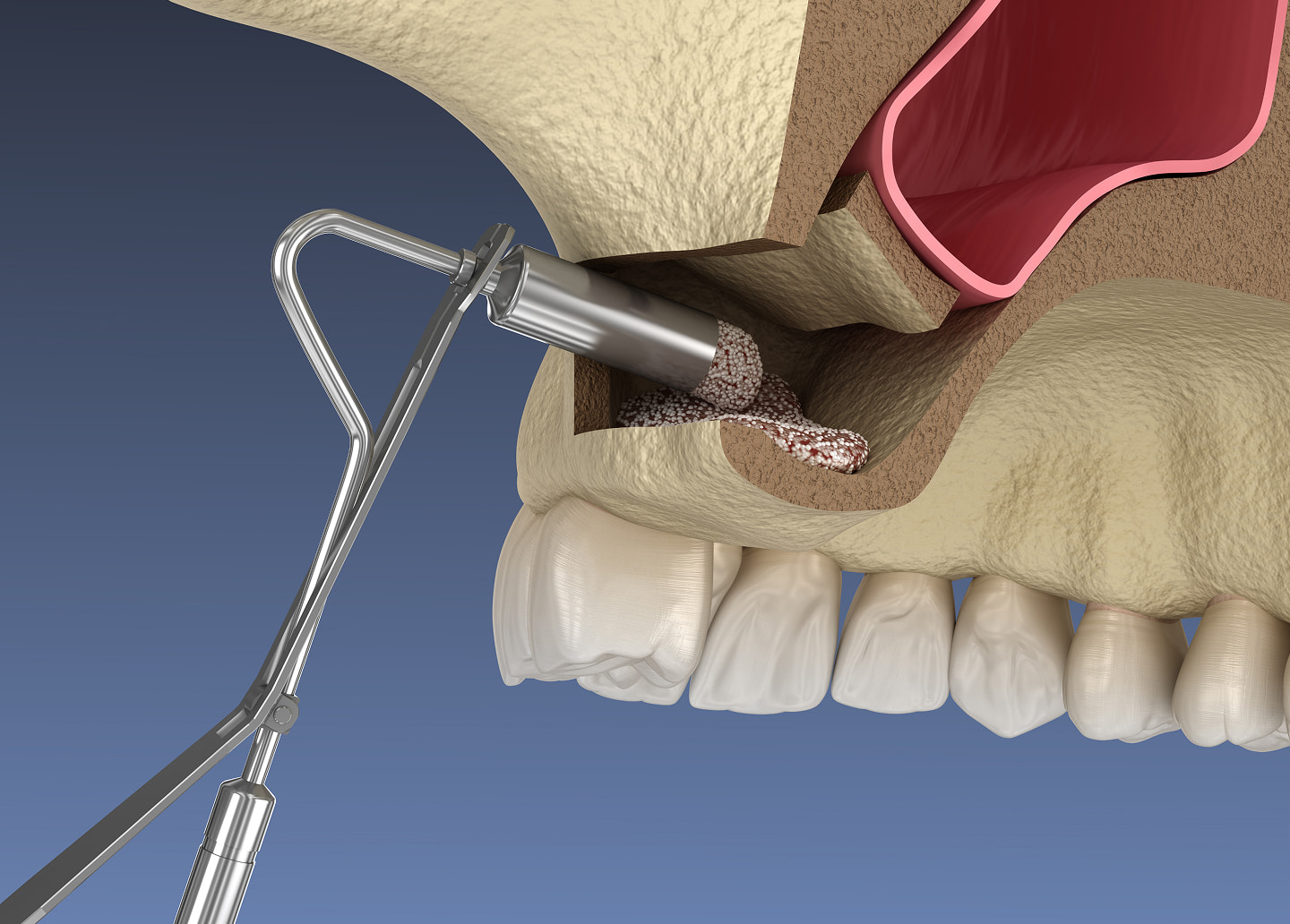 Bone grafting procedure to rebuild jawbone for dental implants