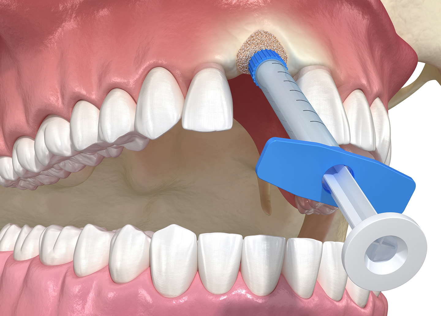 Sinus lift procedure to increase bone height for upper dental implants