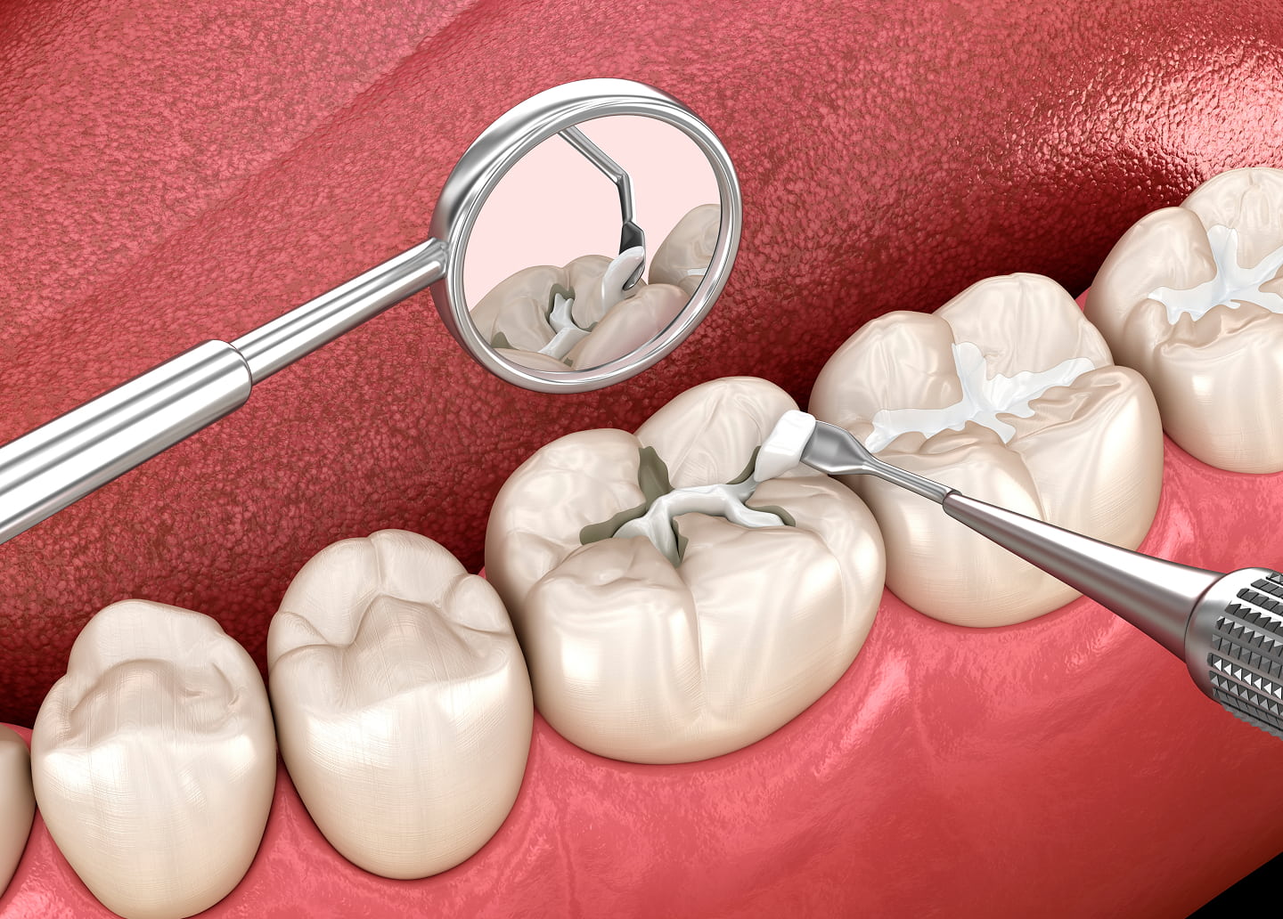 Protective dental sealants applied to back teeth to prevent cavities