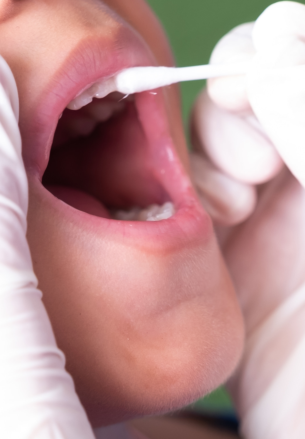Fluoride Treatments Banner Image