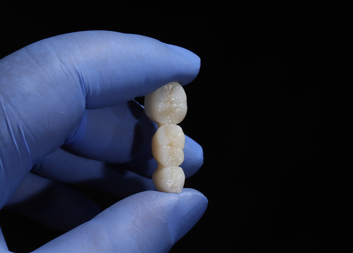 Implant-supported bridge replacing multiple missing teeth