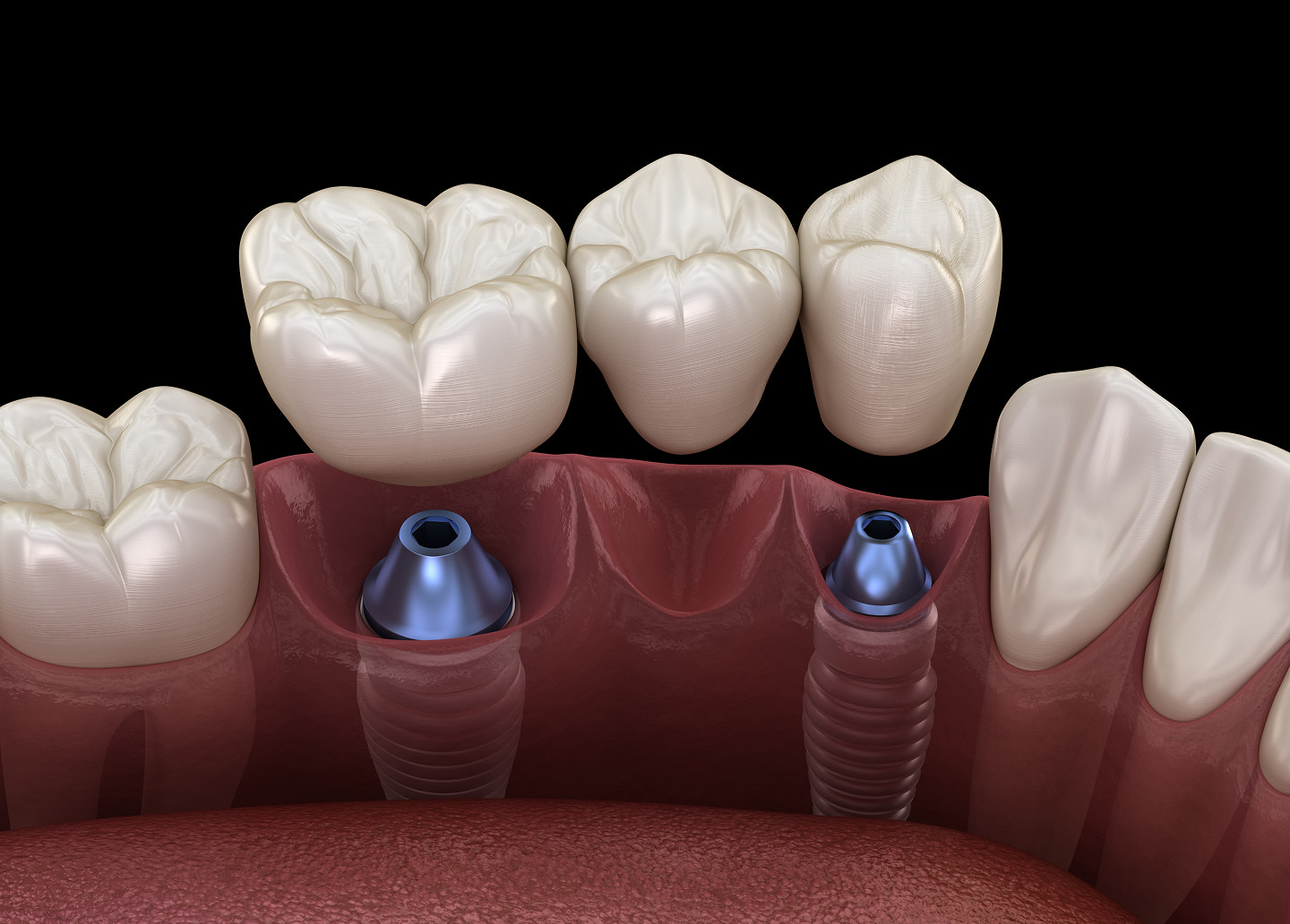 Long-lasting implant-supported dental bridge for multiple missing teeth