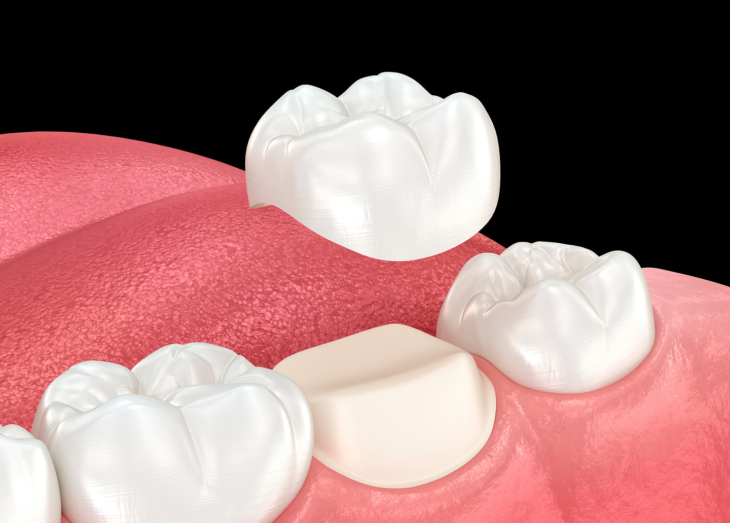 Explanation of metal-free crowns, which are made from materials like porcelain or zirconia to look like natural teeth