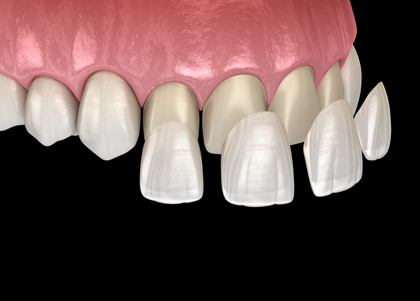 Porcelain veneers for a bright, natural-looking smile transformation