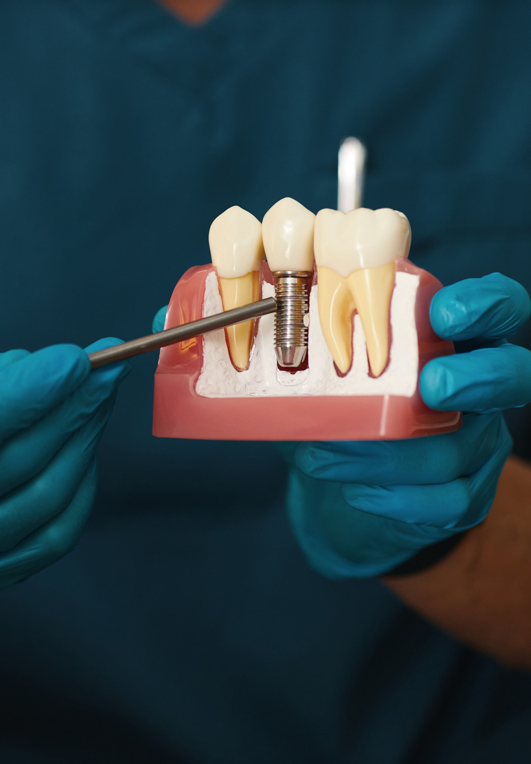 Single Tooth Implants Banner Image