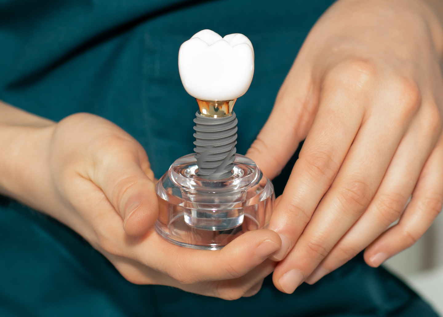 A single tooth dental implant with a titanium post, abutment, and crown replacing a missing tooth