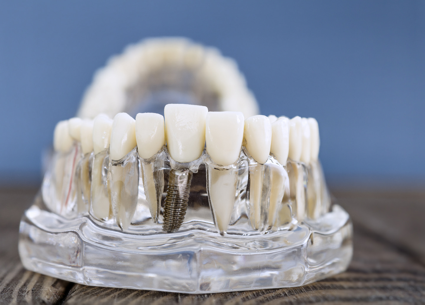 The long-term durability of a dental implant and its crown