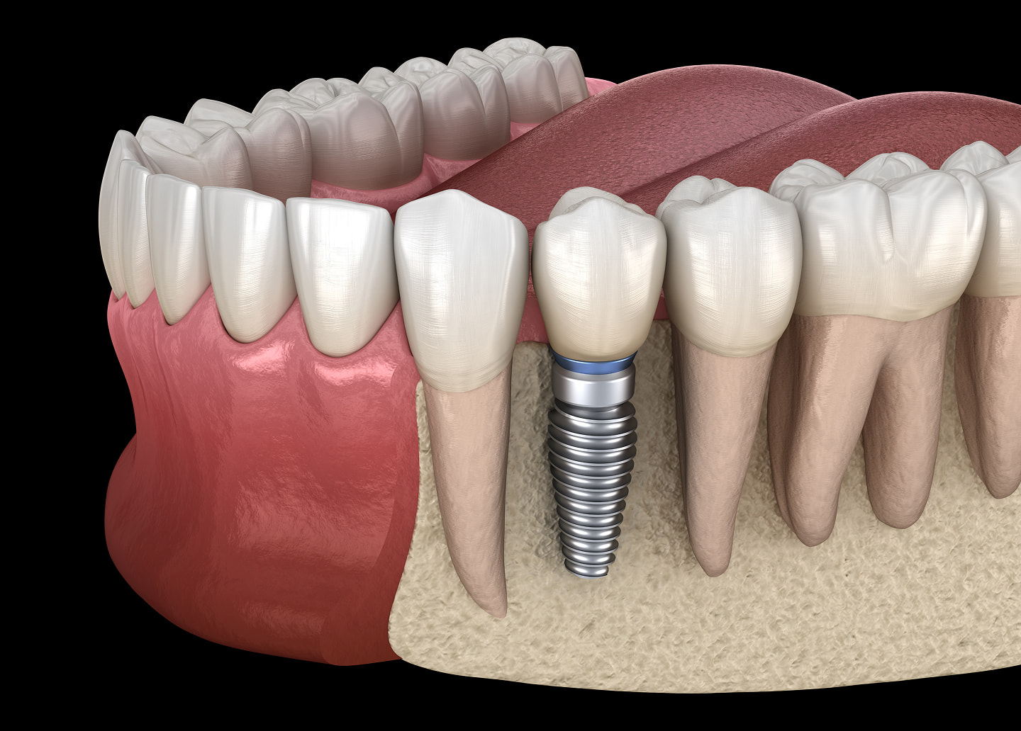 Tips for caring for a single dental implant, including brushing, flossing, and regular dental visits