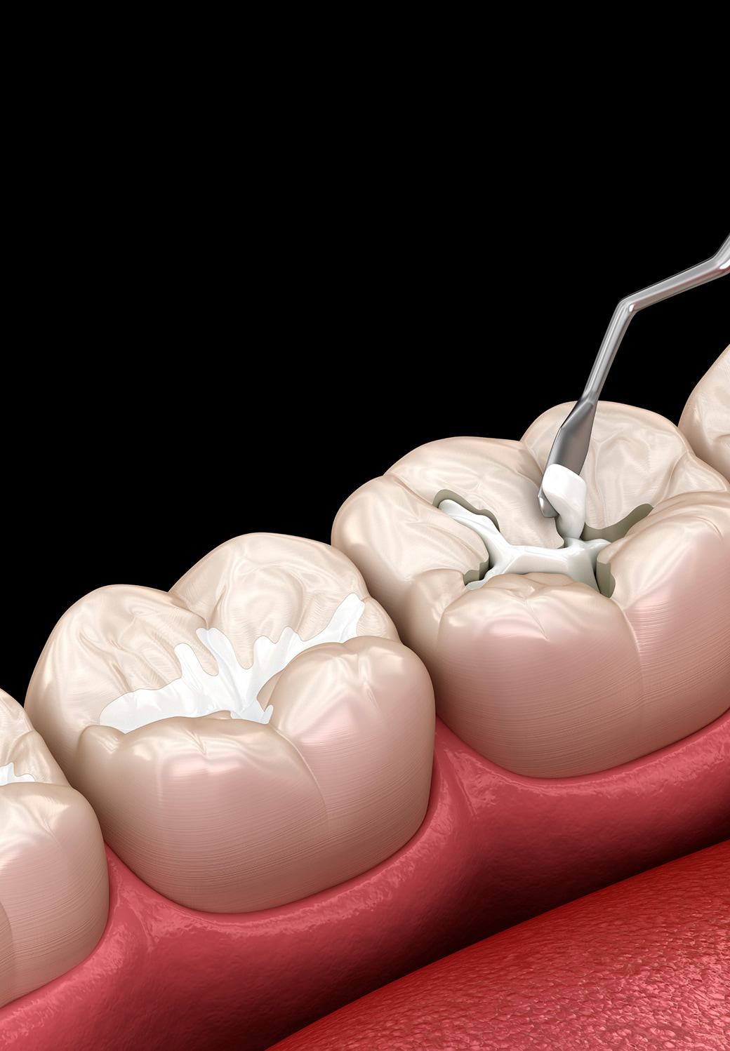 Tooth Colored Fillings Banner Image