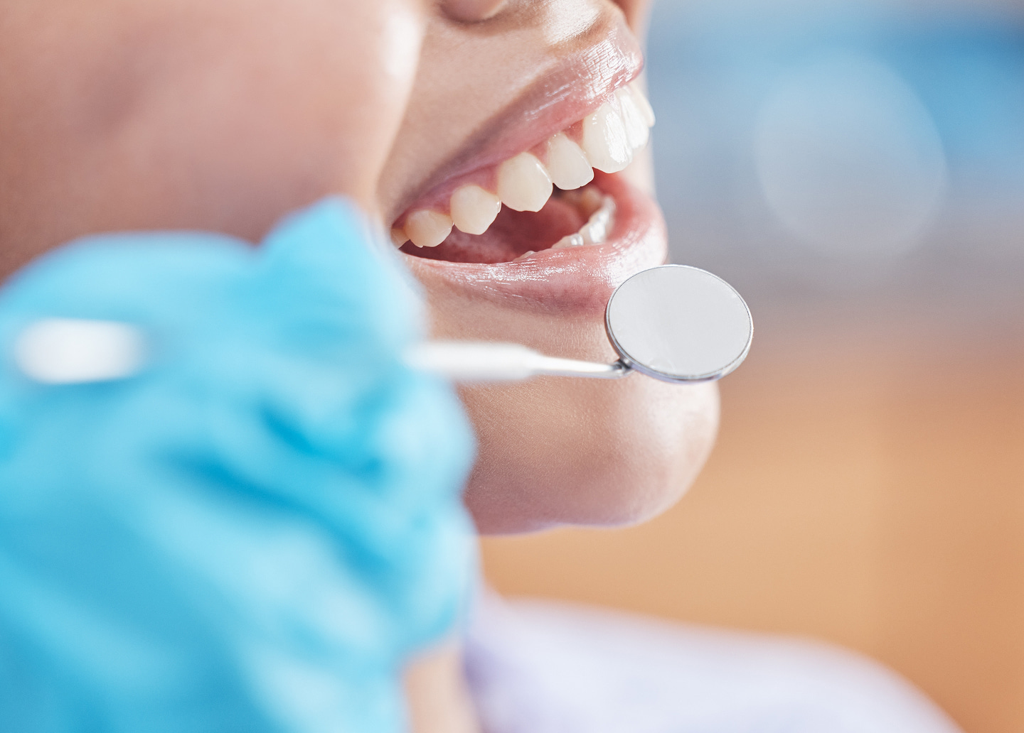 Tooth-colored fillings for natural-looking cavity treatment at Southern Smiles
