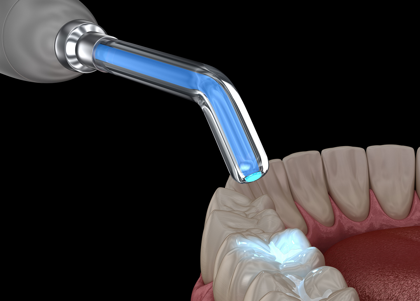 Tooth-colored composite fillings for natural-looking dental restorations at Southern Smiles