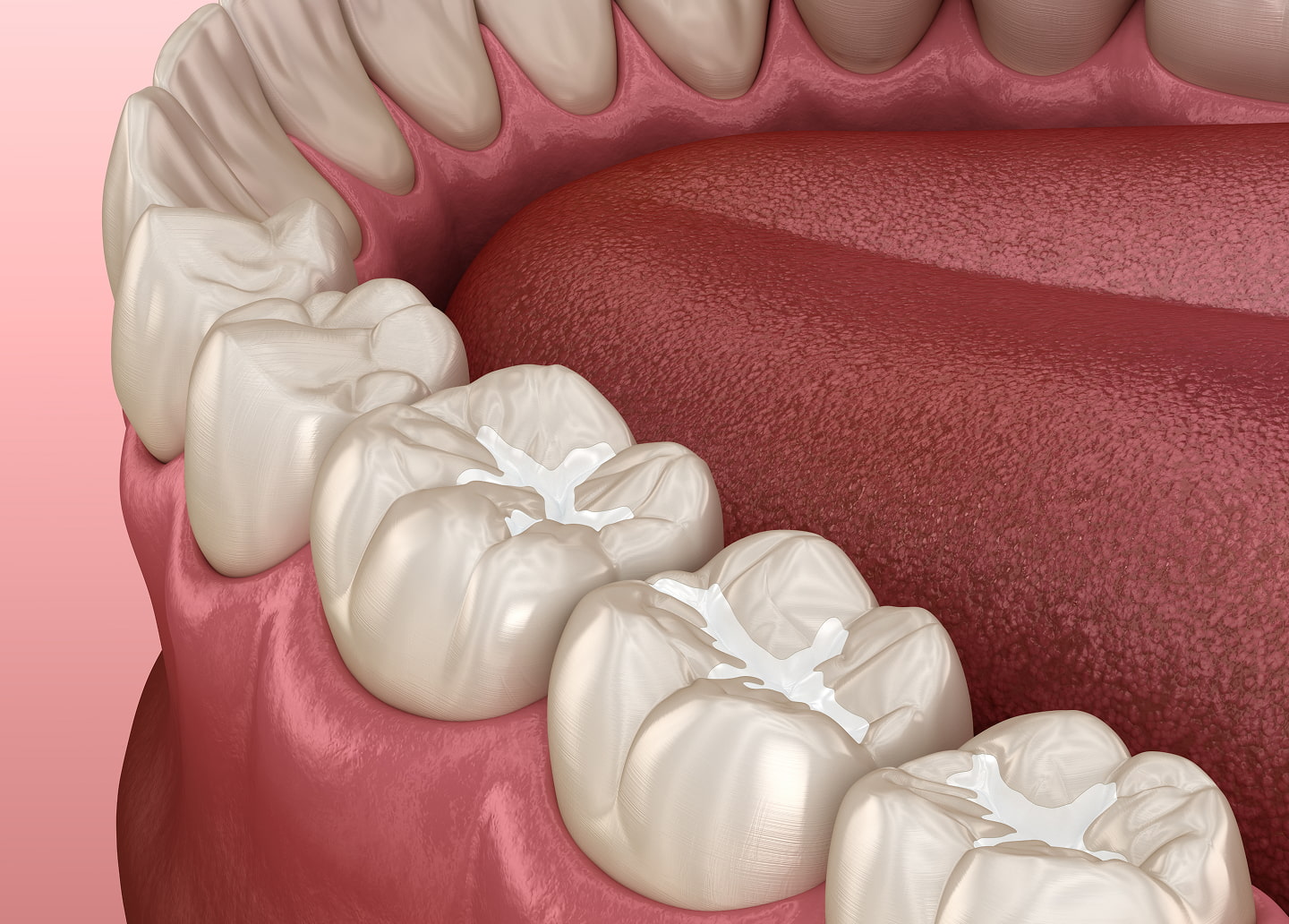 Longevity of tooth-colored fillings and tips to protect them at Southern Smiles